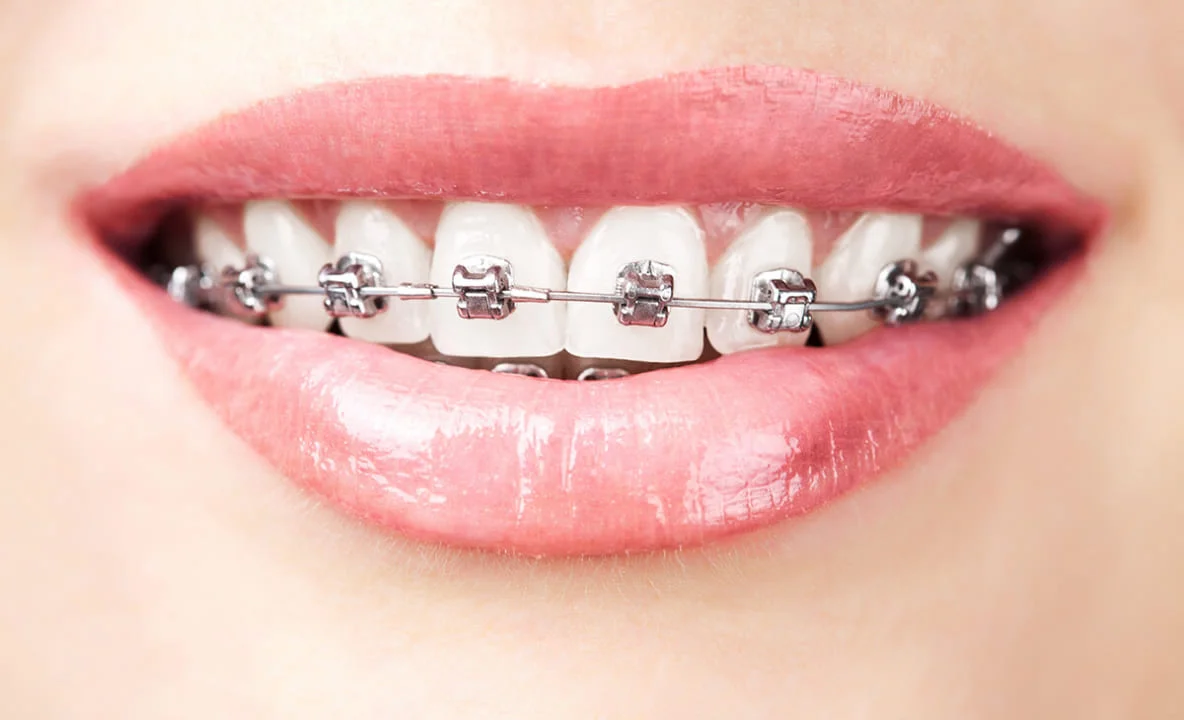 braces