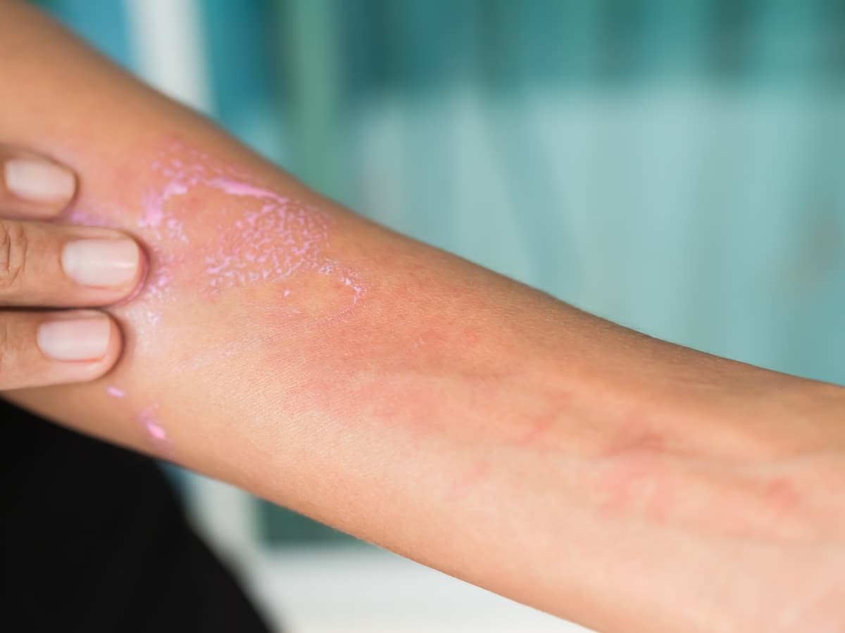 Frau mit Neurodermitis am Arm