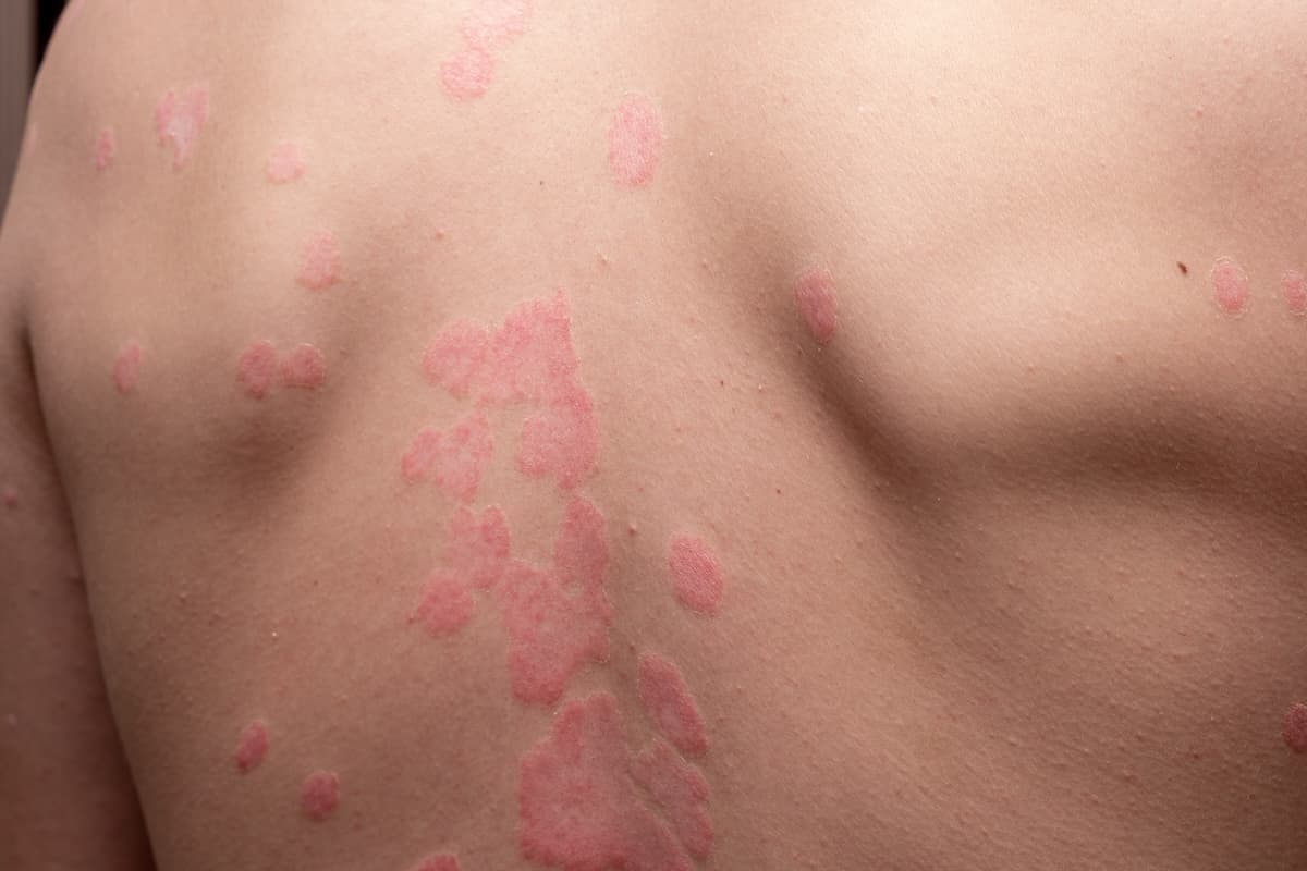 Typische Flecken auf der Haut bei Psiorasis