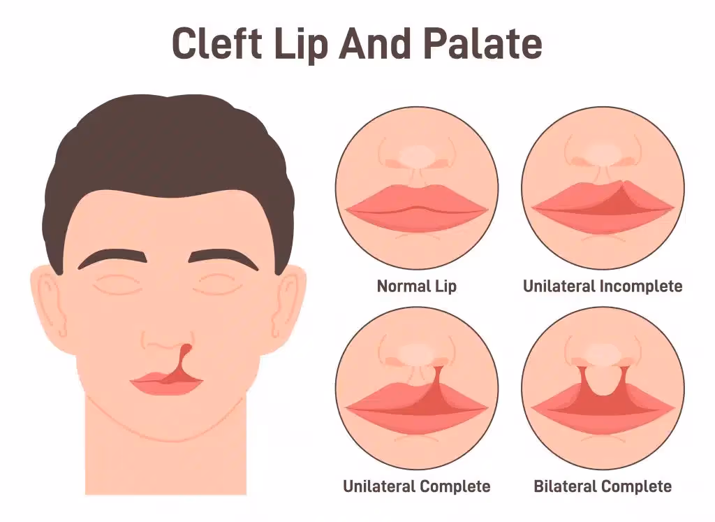 Why Multidisciplinary Teams Treat Cleft Lip & Palate