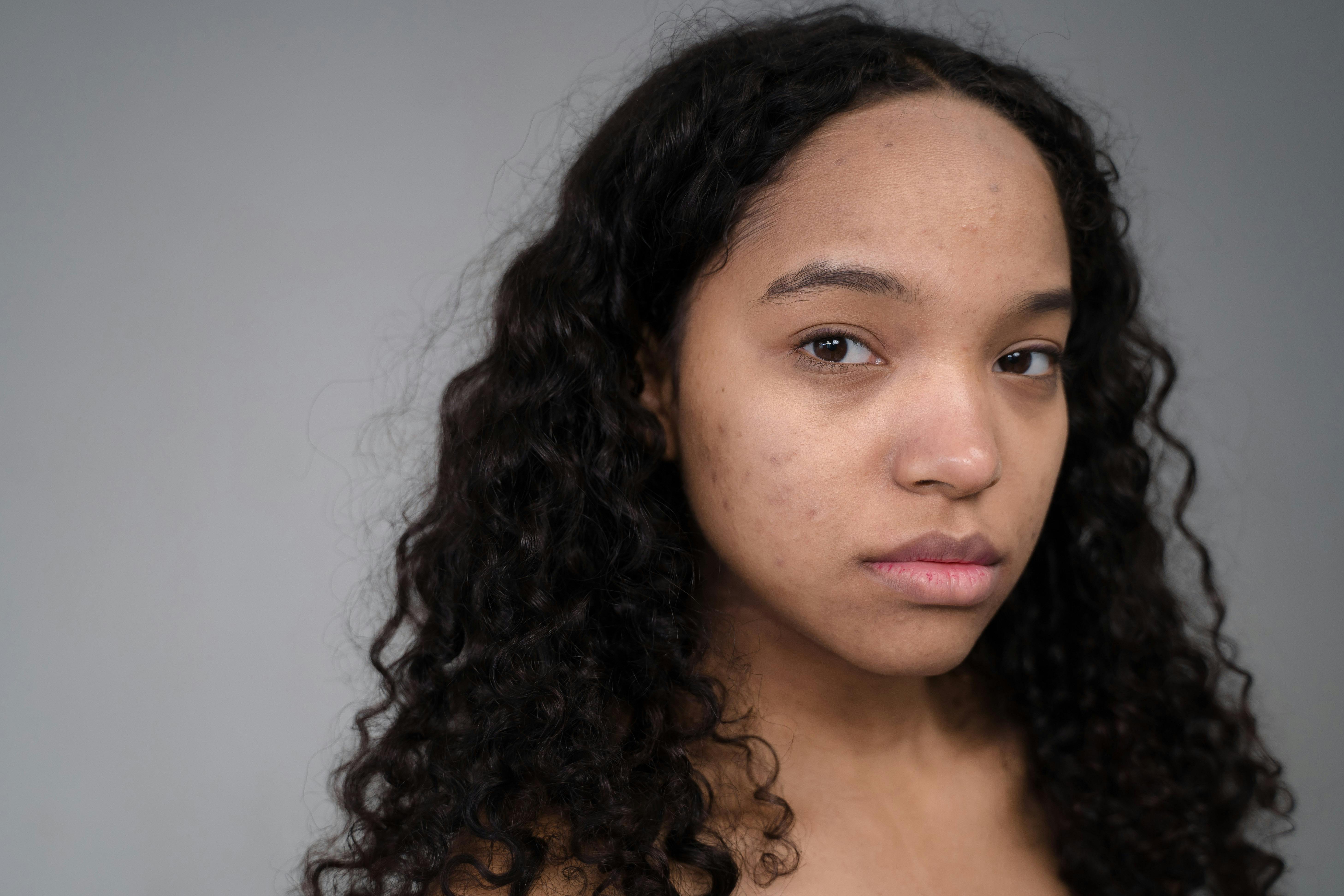 Acne scar and active acne treatment at a skin clinic in Kochi and Tirur