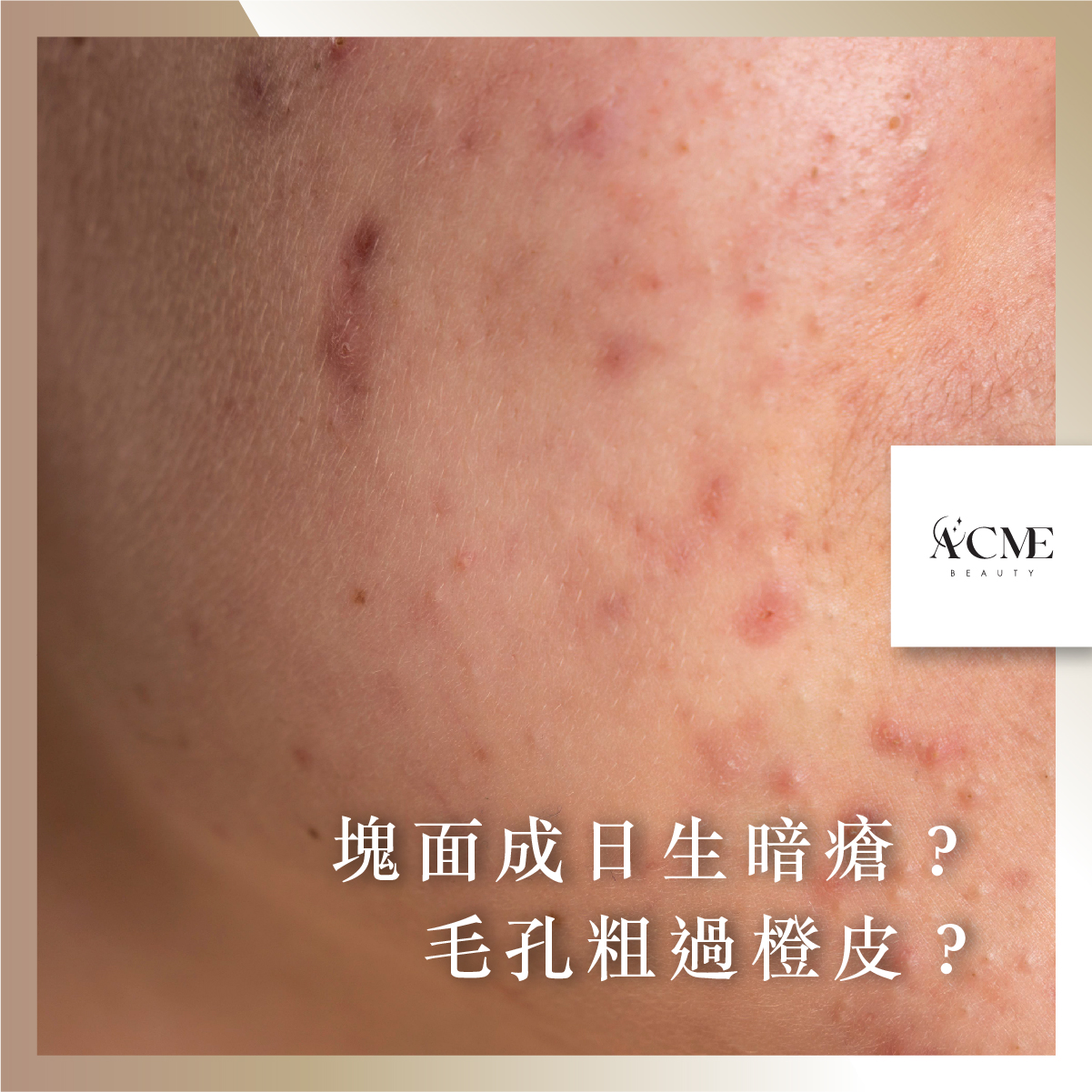 AcmeBeauty-想輕鬆獲得小蠻腰？