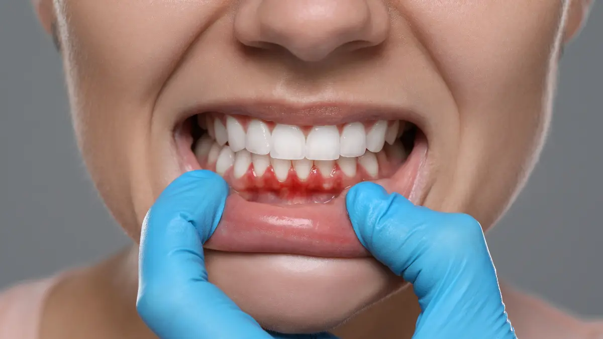 krema na bazi ricinusovog ulja za desni 