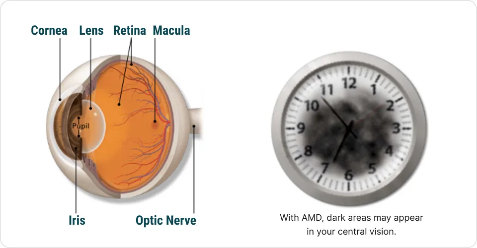 macular degeneration diagram