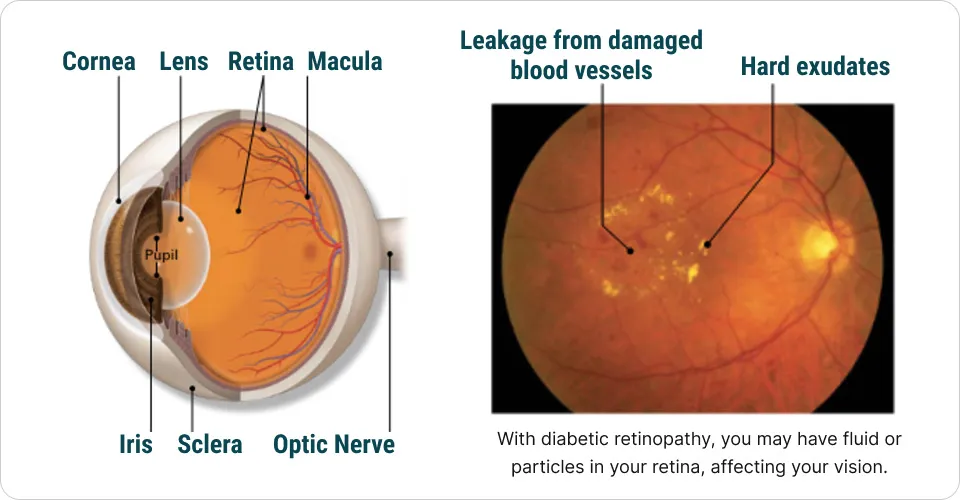 detached retina diagram