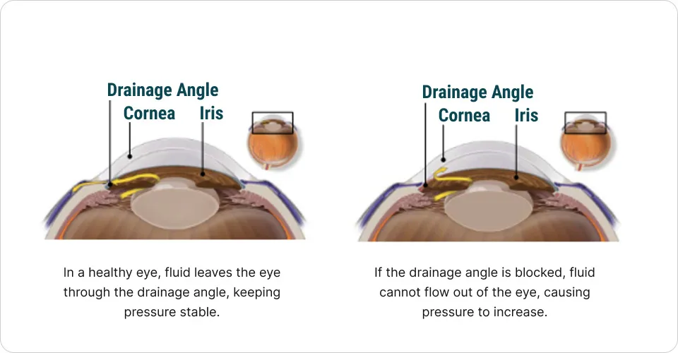 glaucoma diagram