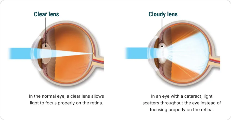 cataract diagram
