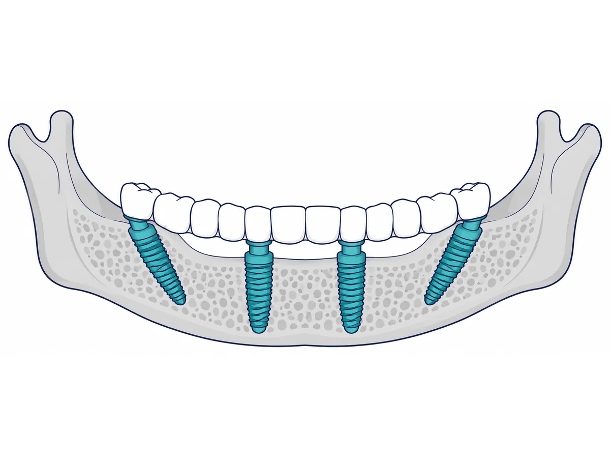 All-on-4 implant positions: two straight implants at the front of the jaw and two tilted implants at the back, joined by one bridge