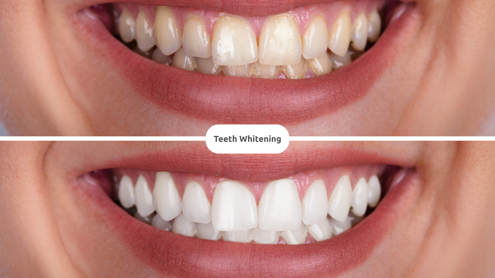 Teeth Whitening: Your Complete Guide | Bentley Plaza Dental Blog