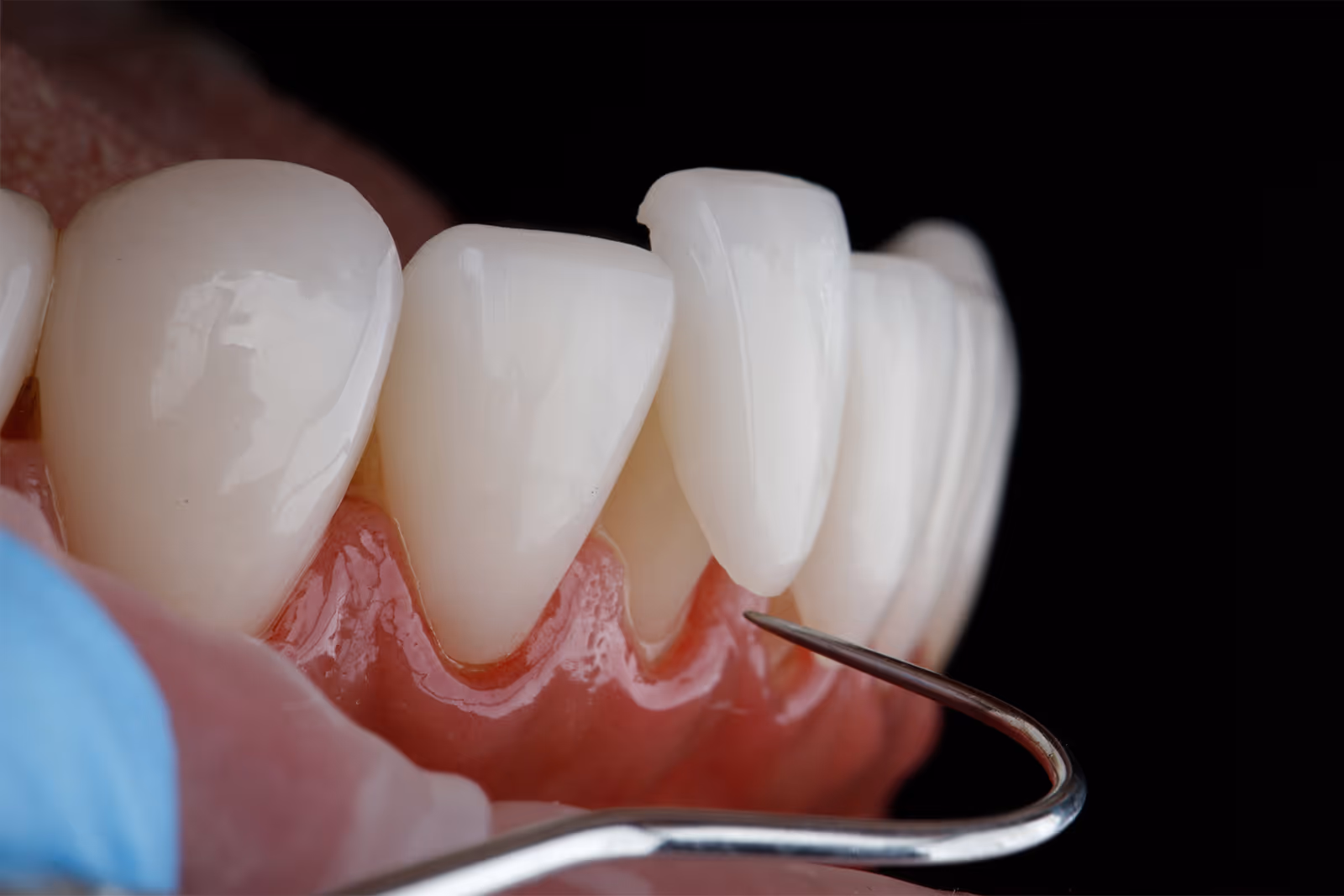 Closeup of a natural-looking veneer made of the highest quality material in Houston, TX.