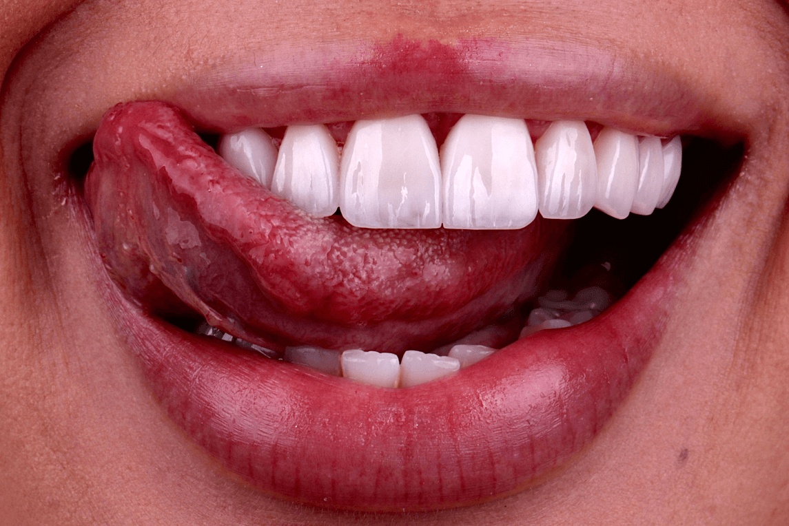 Close-up of a bright smile showing porcelain veneers and healthy gums by the best dental veneers provider in Houston.