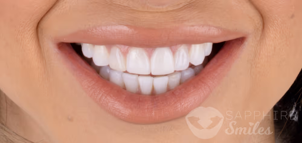 Before and after of patients teeth after a Smiles Family Dentistry Smile Makeover