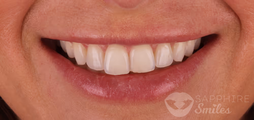 Before and after of patients teeth after a Smiles Family Dentistry Smile Makeover
