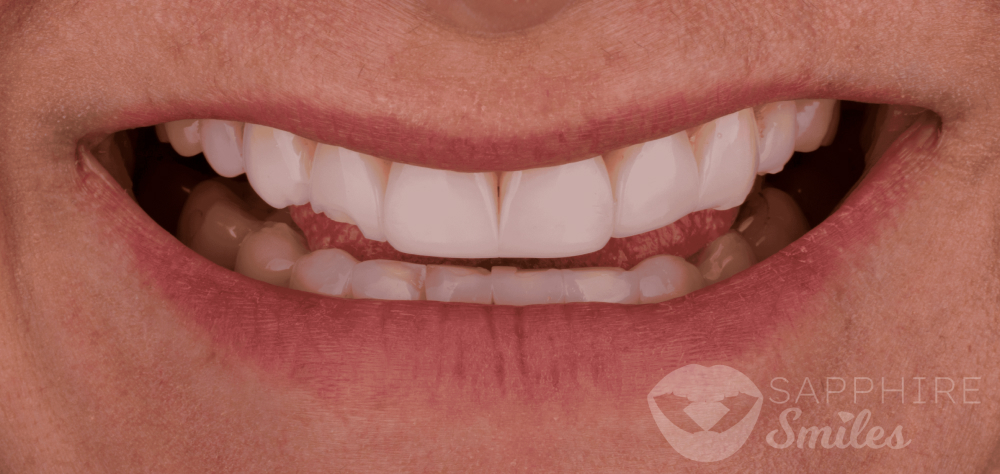 Before and after of patients teeth after a Smiles Family Dentistry Smile Makeover