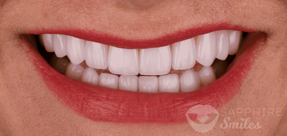 Before and after of patient's teeth after receiving veneers