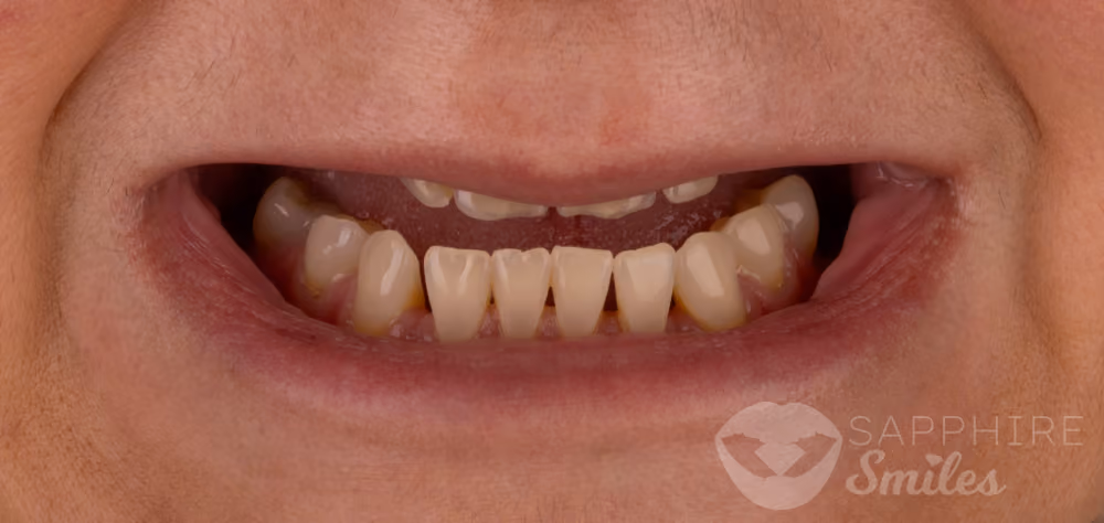 Before and after of patients teeth after a Smiles Family Dentistry Smile Makeover