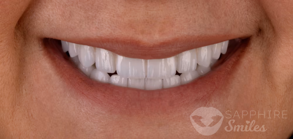 Before and after of patient's teeth after receiving veneers