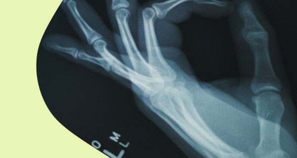 A hand with a broken bone.