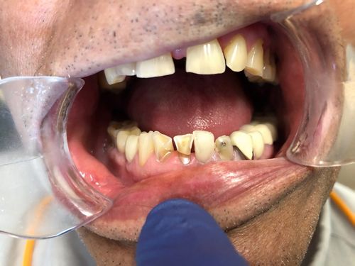 Park Dental Ohio - Cosmetic Bonding Before