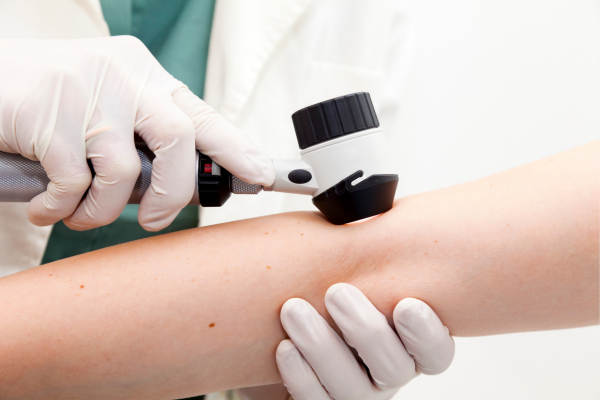Over 112,000 Americans Estimated to Be Diagnosed with Invasive Melanoma in 2026 