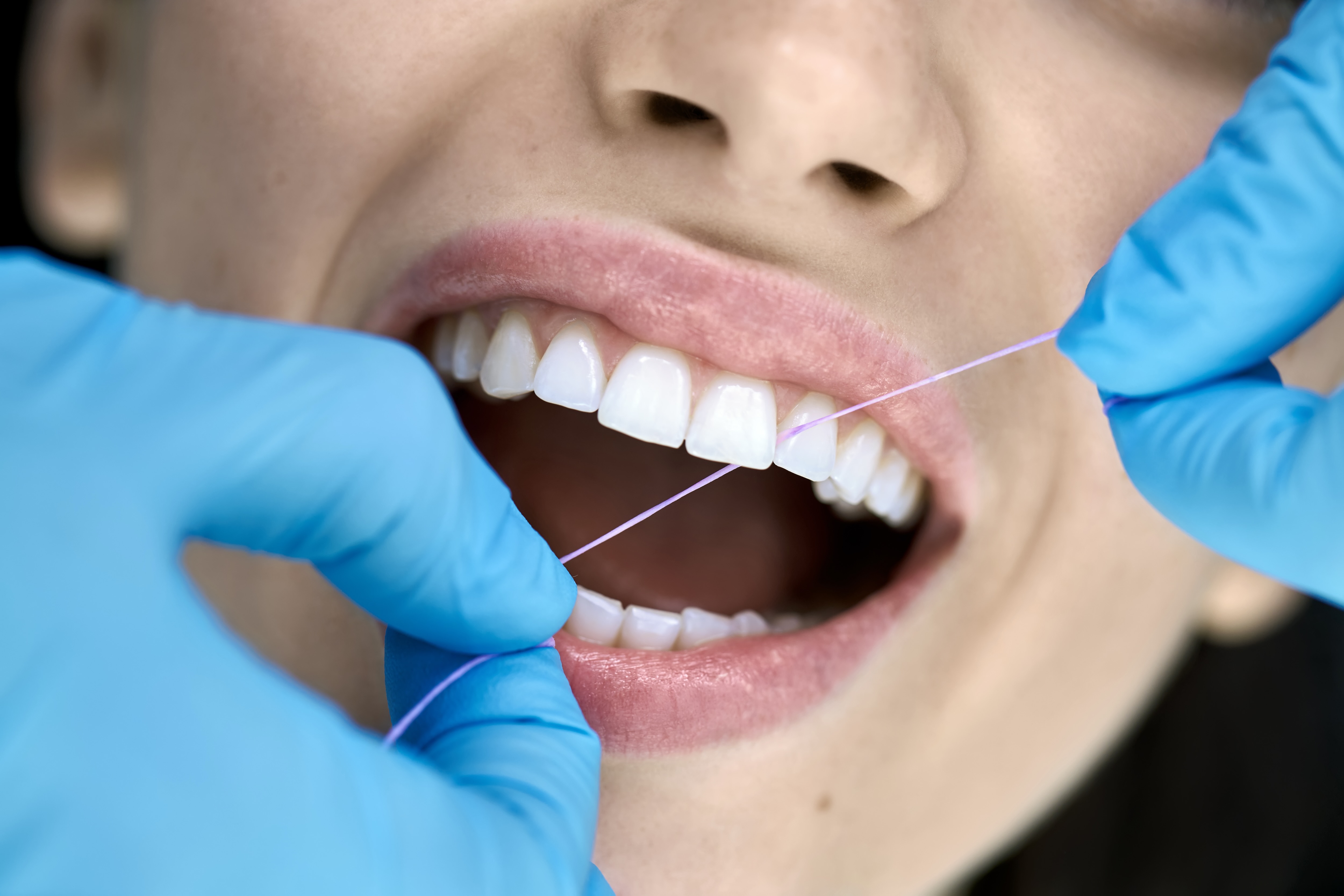 dental cleaning in redmond