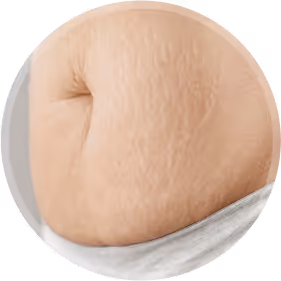 close up view of belly stretch marks