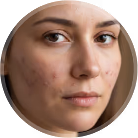 close up view of visible acne scars