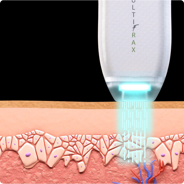 MultiFraX preview of laser penetration depth on the skin