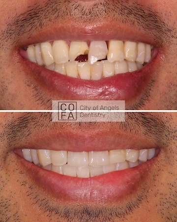 A before and after photo of a smiling patient, before showing a cracked tooth and the after showing a the tooth restored with natural results