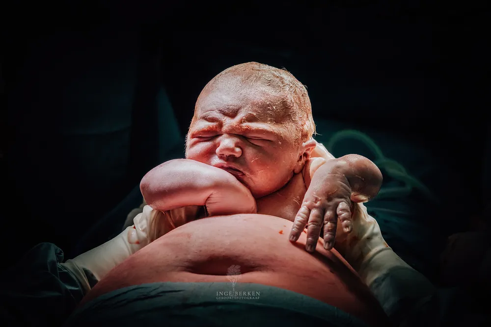 Mother-Assisted Caesarean (MAC): When Birth Lies in the Mother’s Hands