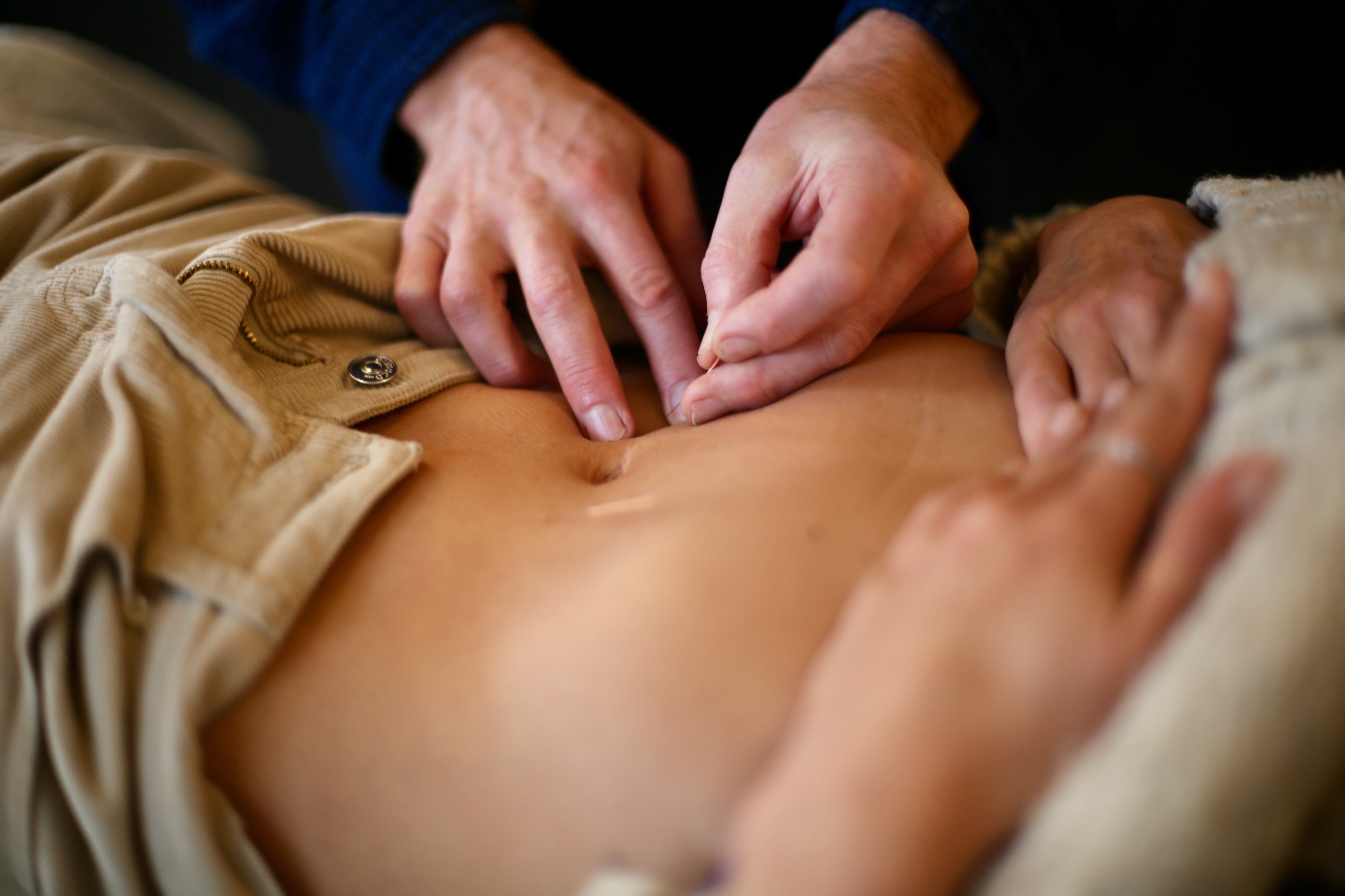 Close-up of hands inserting acupuncture needles into a person's abdominal skin during treatment.