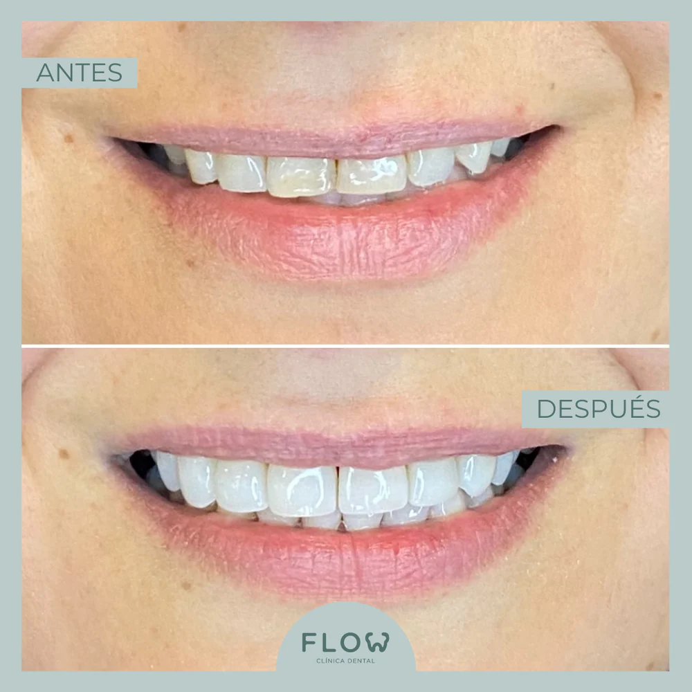 a woman's teeth before and after whitening