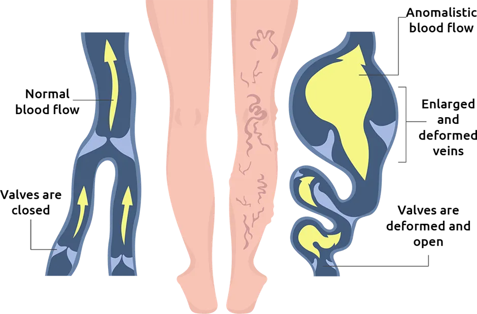 varicose veins symptoms