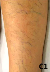 why are my veins so visible