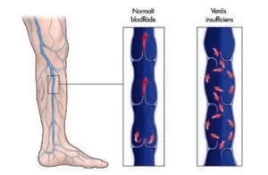 Normalt blodflode vs venös insufficiens