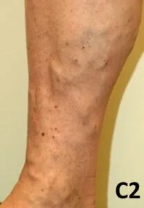 Åderbråck C2 CEAP Klassifikation