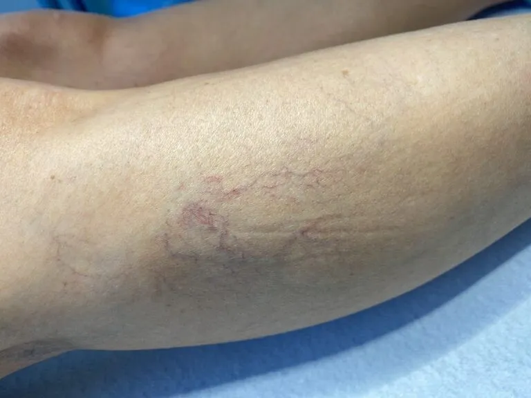 Ytliga blodkärl på benen – ådernät