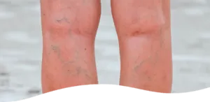 Ådernät i knävecken