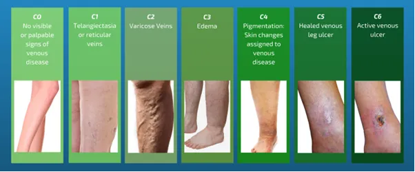 Explaining CEAP Classifications for Vein Treatment in Arkansas | Ozark Regional Vein & Artery Center
