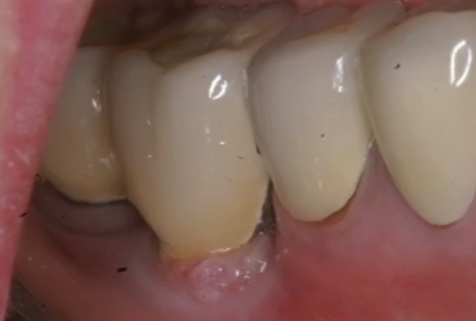 Inflammation occurs around abutment in the mandibular molar gum