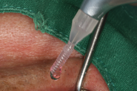 Disinfection liquid being injected using Gingistar with vibration