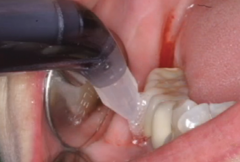 Treating inflammation around the abutment using Gingistar