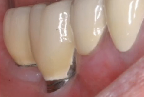 Inflammation is healed after using Gingistar