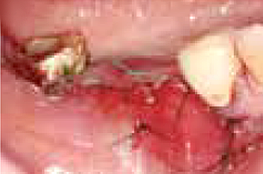 Suture