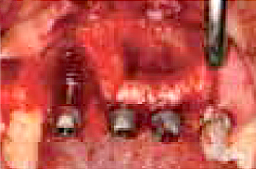 Placing Fixture (Implant placement at #11, #21, #22
