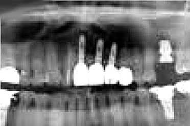 X-ray after final prosthetics