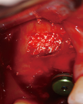 Bone Graft with PRP, Autobone & Mineral Bone