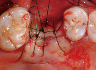 Suture