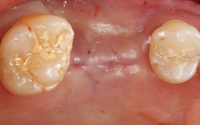 (5 Months after Surgery) Well-Formation of Bone (1)