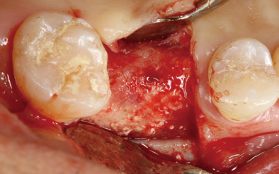 (5 Months after Surgery) Well-Formation of Bone (2)
